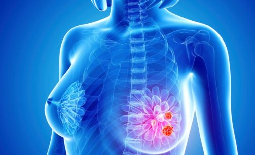 001_cancer-de-mama_o-que-e_2